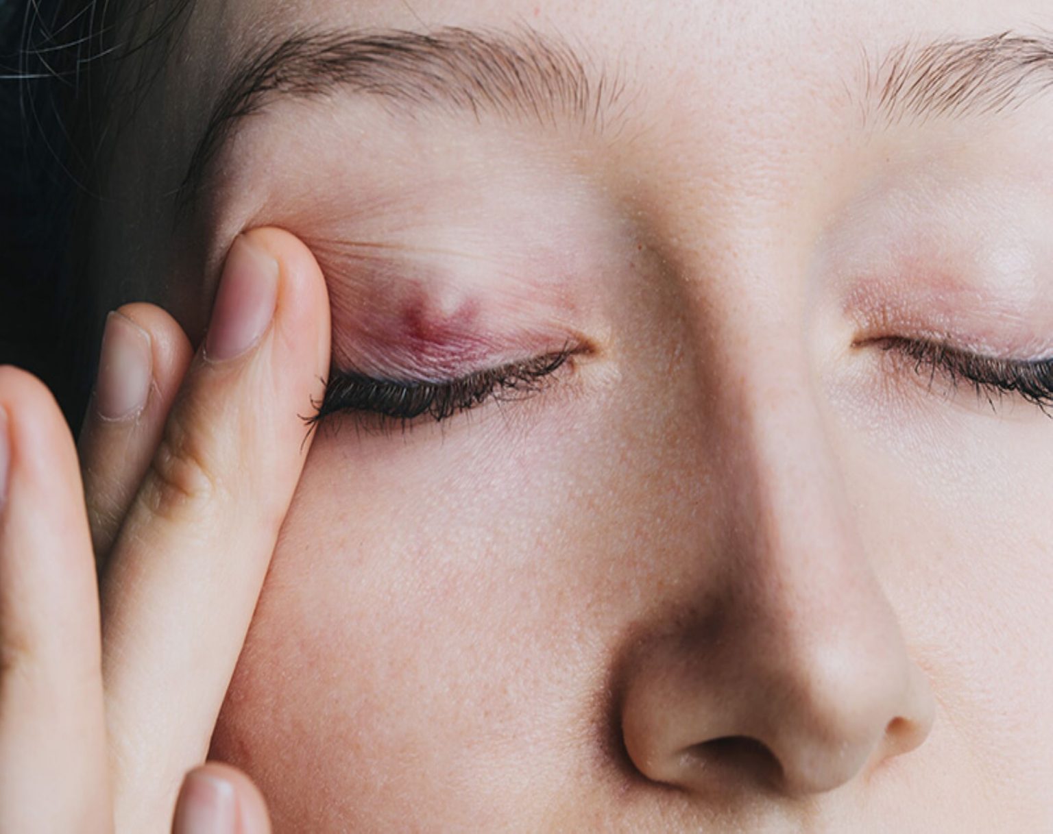 Eyelid Bump Got You Down? Discover If It’s a Chalazion and How to Fix It Fast!